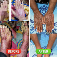 Vaidban Psoriatic Arthritis Combo Pack - Comprehensive Skin Treatment Solution thumbnail 2